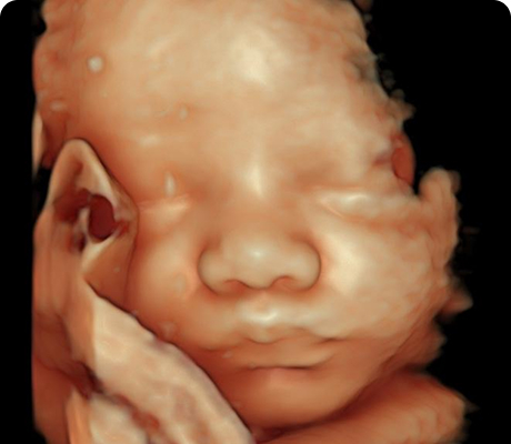 Ultrasonido del Tercer Trimestre