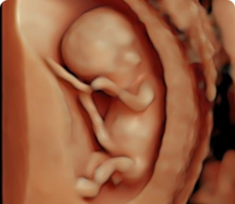 Ultrasonido 11-14 y Estudio Combinado del Primer Trimestre