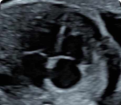 Ecocardiograma Fetal (básico y avanzado)