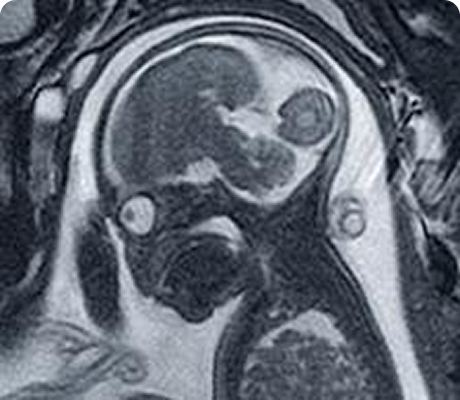 Resonancia Magnética Fetal