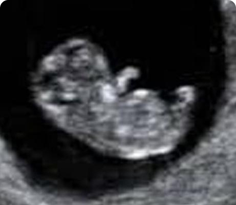 Ultrasonido del Primer Trimestre Temprano